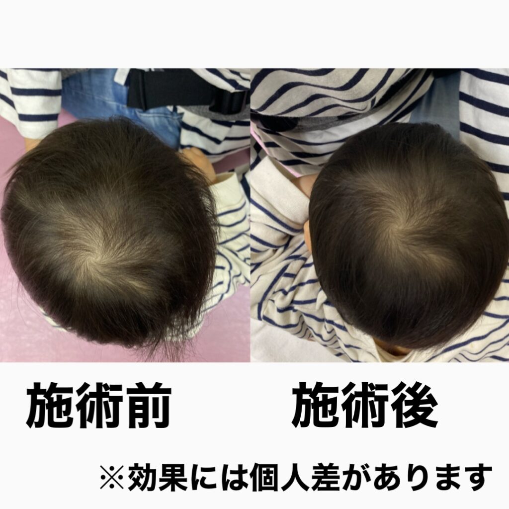 斜頭・ヘルメット頭・絶壁などの様子です