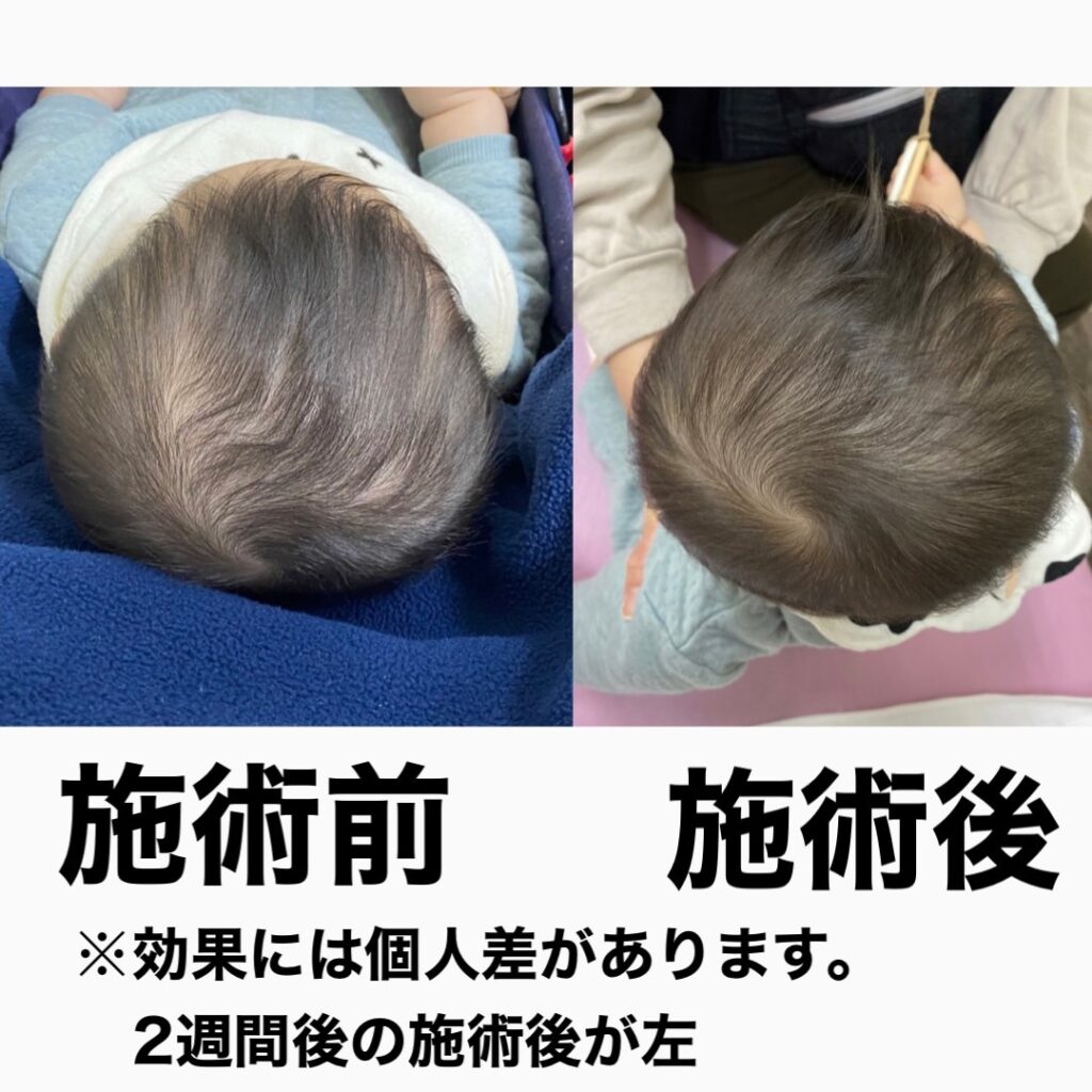 赤ちゃんの絶壁・斜頭症・ヘルメット頭が不安な方
