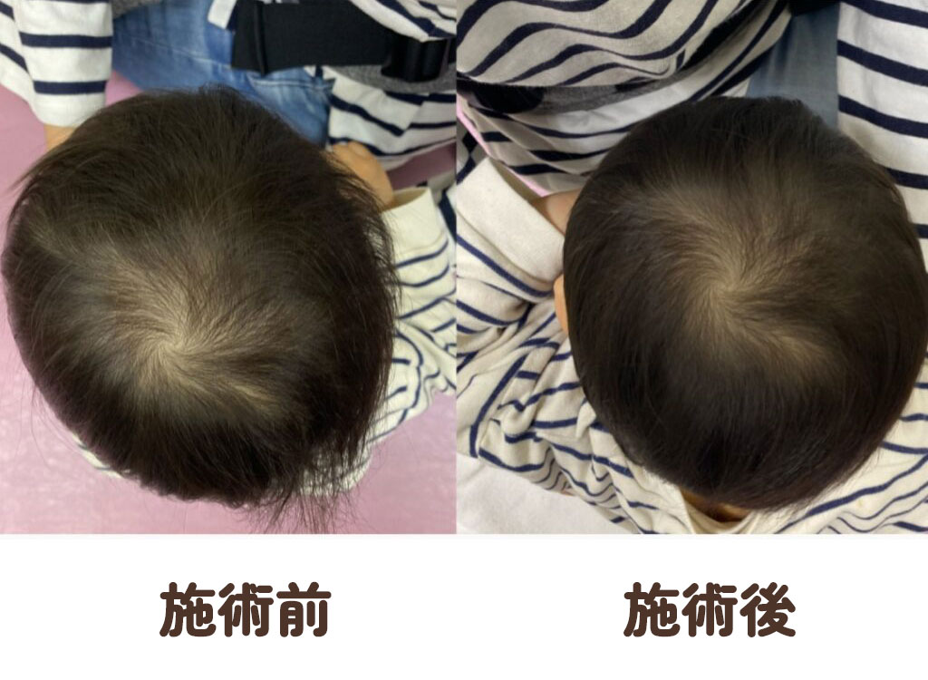 赤ちゃんの斜頭症・絶壁・頭の形の症例写真1