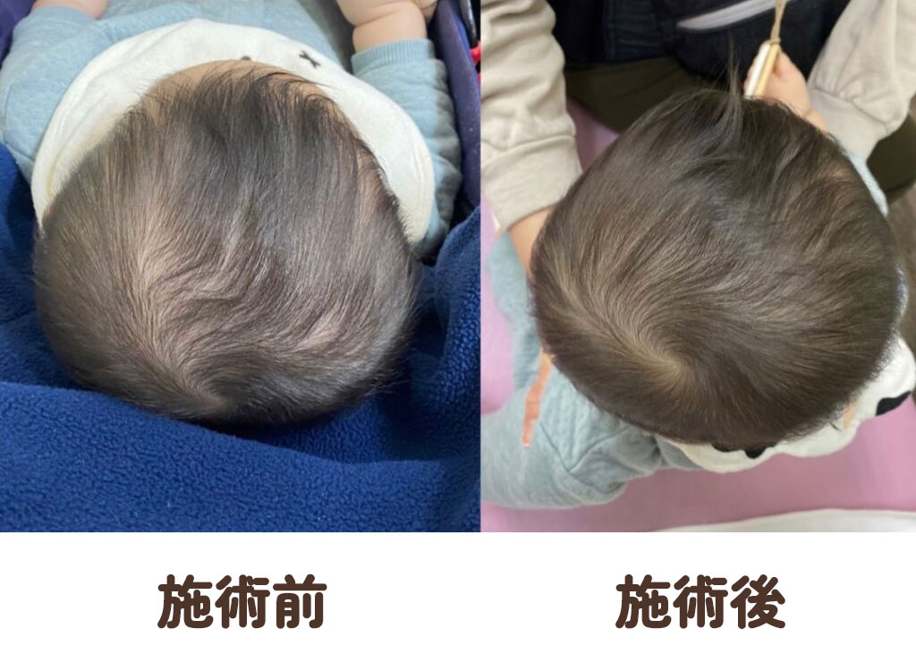 赤ちゃんの斜頭症・絶壁・頭の形の症例写真2